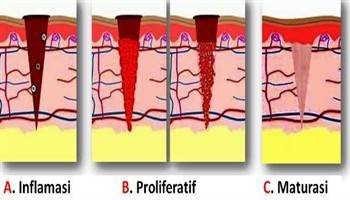 Penyembuhan Luka Definisi Penyebab  Fase Jenis Lama 