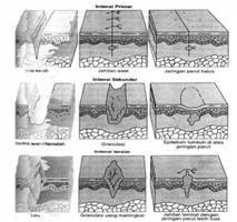 Gambar Penyembuhan Primer