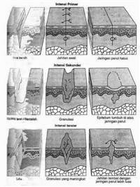 Gambar Penyembuhan Sekunder