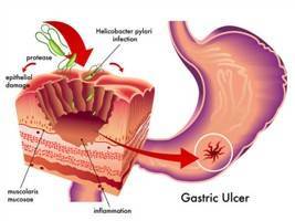 Gambar Perforasi Lambung