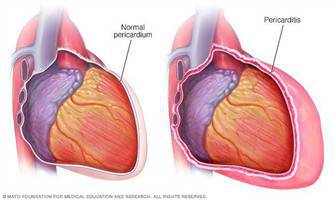 Gambar Perikarditis