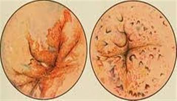 Gambar Periproctitis