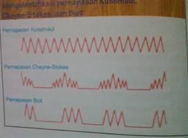 Gambar Pernapasan Kussmaul