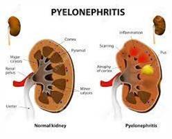 Gambar Pielonefritis