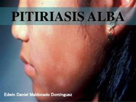 Gambar Pitiriasis Alba