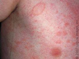 Gambar Pityriasis Rosea