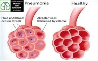 Gambar Pneumonia