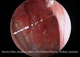 Gambar Post Nasal Drip