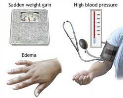 Gambar Preeklampsia