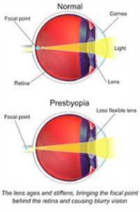 Gambar Presbiopi