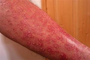 Gambar Psoriasis Tipe 2