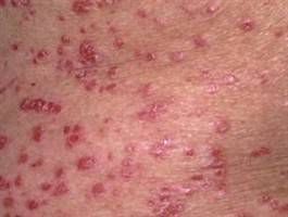 Gambar Psoriasis Gutata