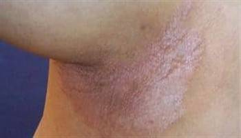 Gambar Psoriasis Inversa