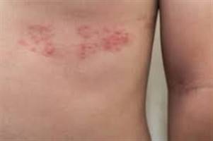 Gambar Psoriasis Ringan