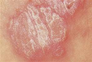 Gambar Psoriasis Vulgaris