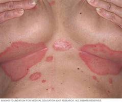 Gambar Psoriasis