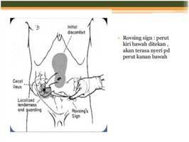 Gambar Rovsing Sign