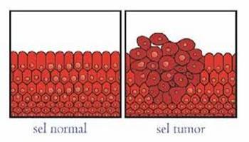 Gambar Sel Tumor