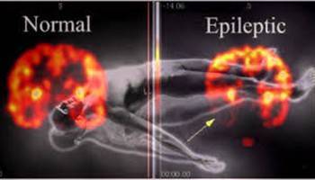 Gambar Status Epileptikus