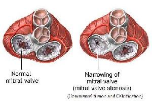 Gambar Stenosis Mitral