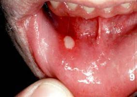 Gambar Stomatitis Aftosa