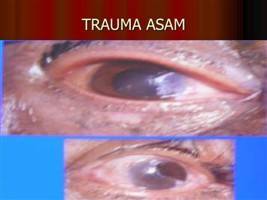 Gambar Trauma Asam Kuat