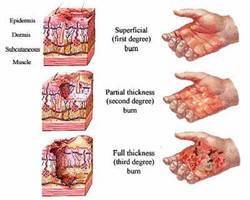 Gambar Trauma Panas