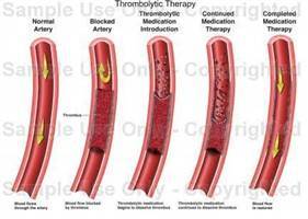 Gambar Trombolitik