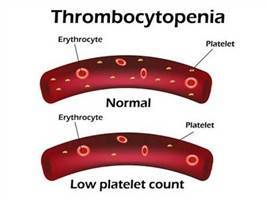 Gambar Trombositopenia