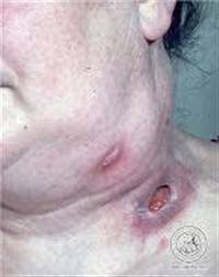 Gambar Tuberkulosis Kutis