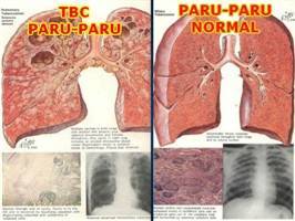 Gambar Tuberkulosis Paru