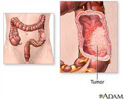 Gambar Tumor Jinak Kolon