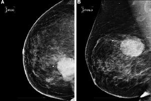 Gambar Tumor Phyllodes