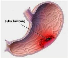 Gambar Ulkus Lambung