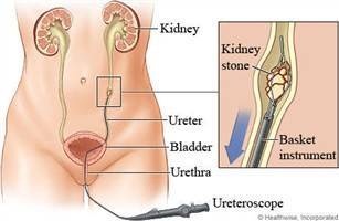 Gambar Ureteroskopi