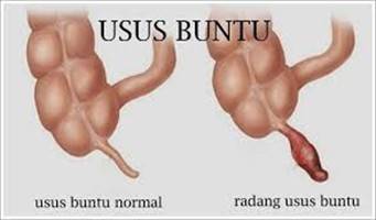 Gambar Usus Buntu