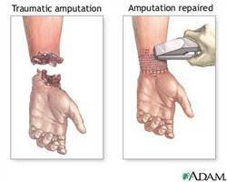 Gambar Vulnus Amputatum