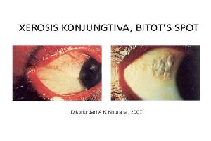 Gambar Xerosis Konjungtiva